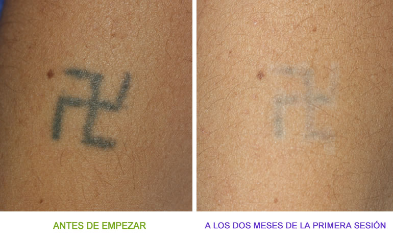 coro vesícula biliar Sustancial Tatuajes Que Pueden Ser Quitados o Eliminados Tatuajes DERMOSALUD