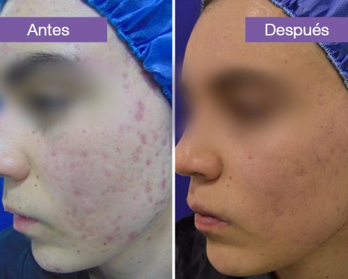 Juan sebastian acne
