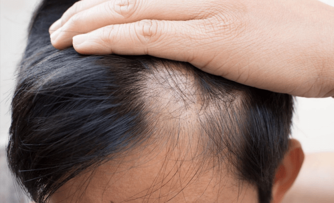 todo lo que debes saber de la alopecia