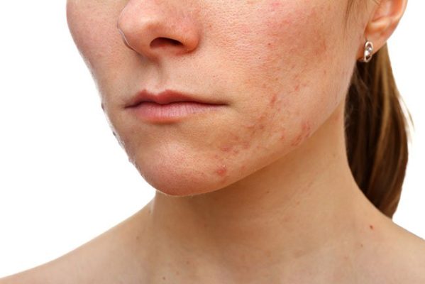 acne en rostro