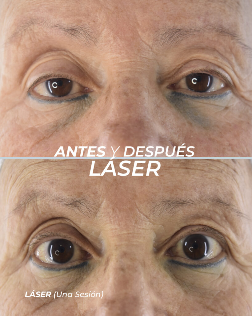 Corrección de Tatuajes 2