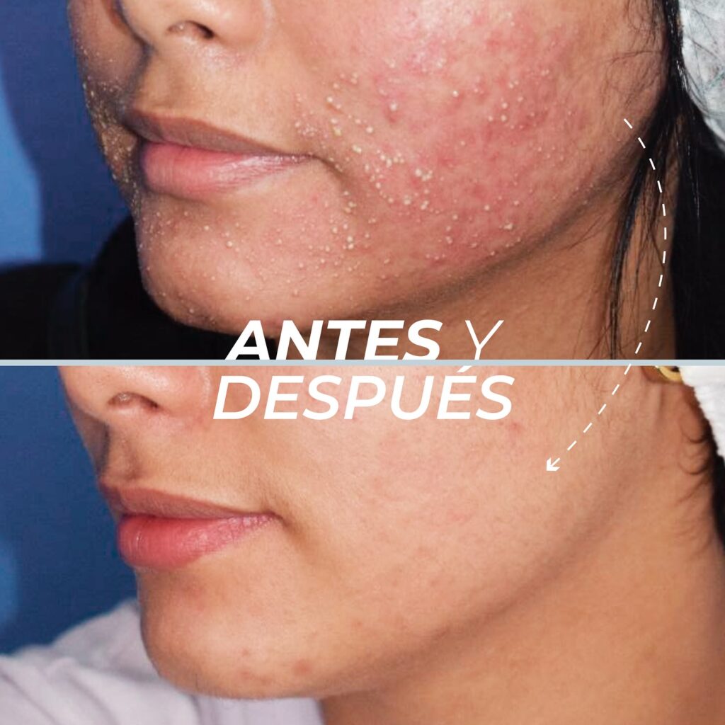 Tratamiento de Foliculitis