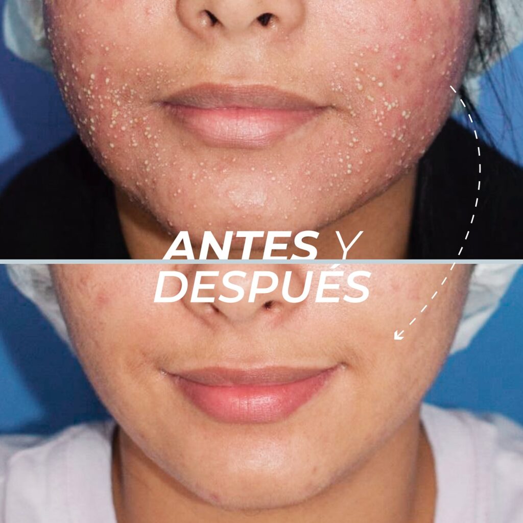 Tratamiento de Foliculitis