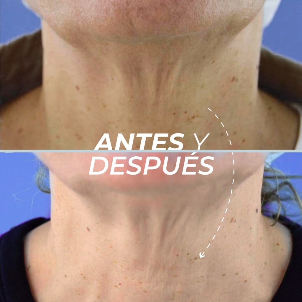 Cuello y contorno facial 2