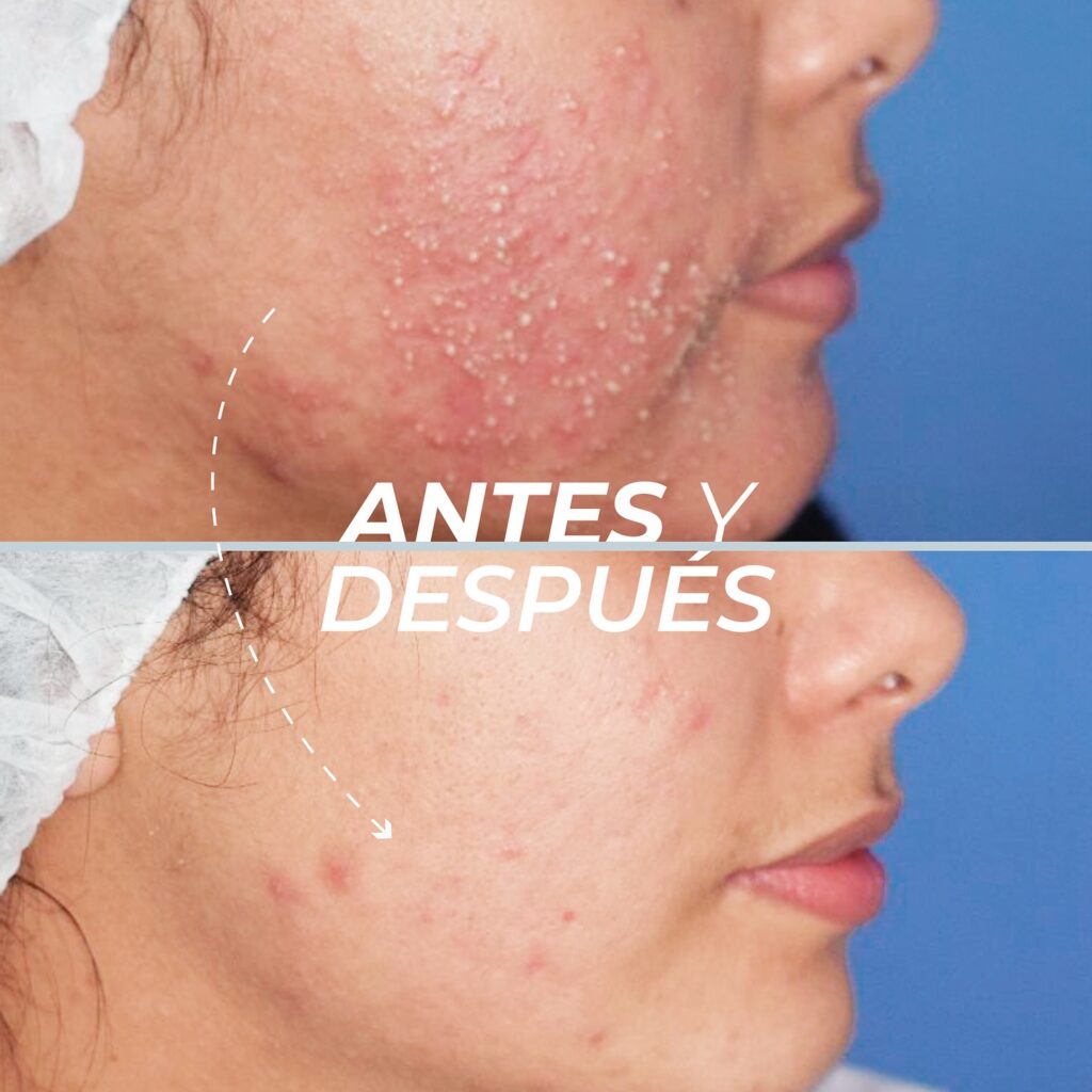 Tratamiento de Foliculitis