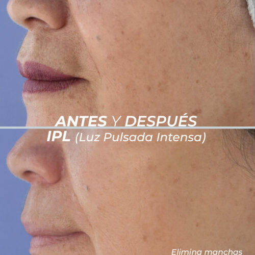Peeling Meline