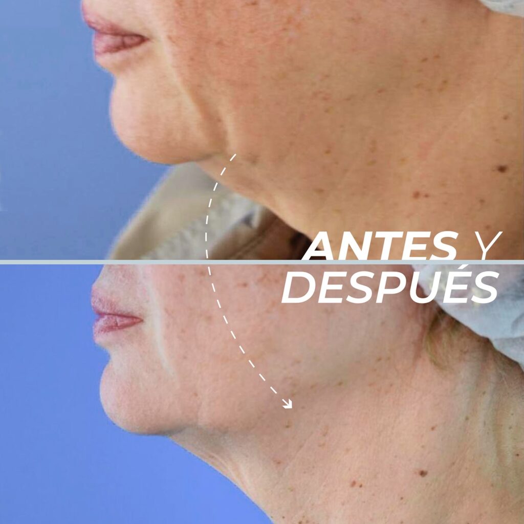 Cuello y contorno facial 3