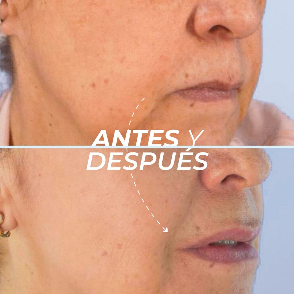 Cuello y contorno facial 4