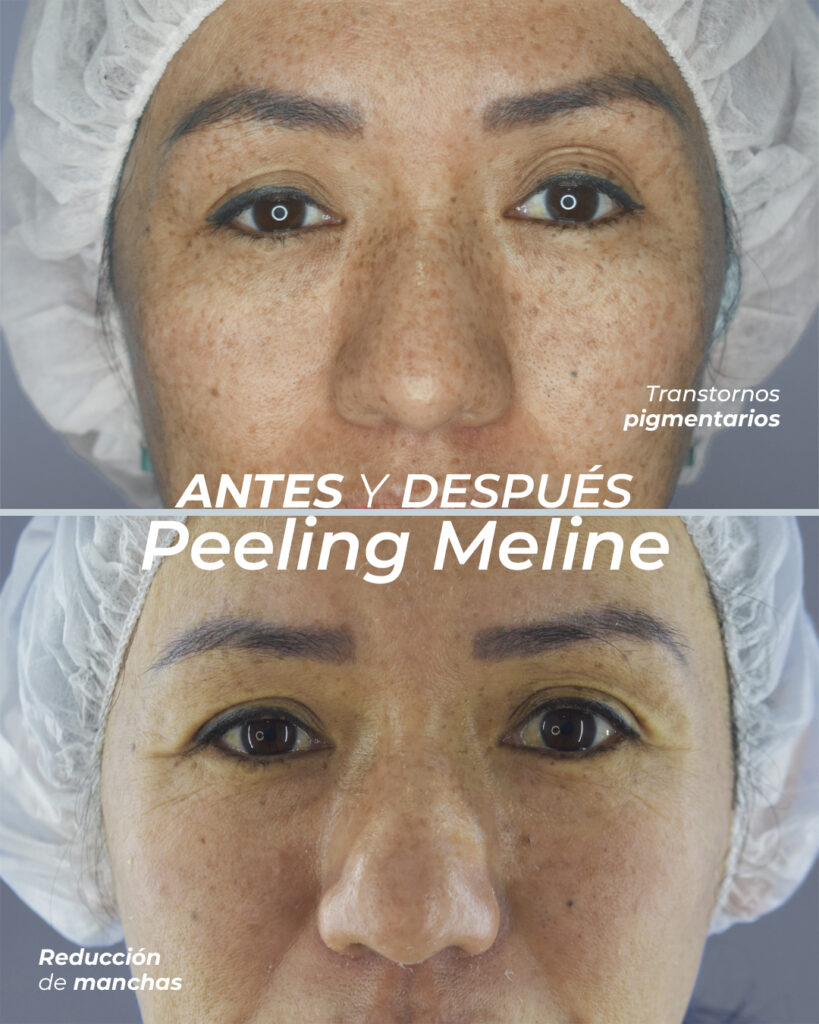 Peeling Meline 2