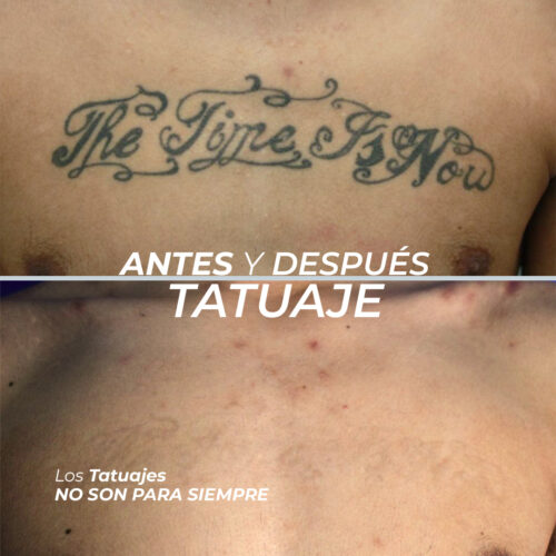 Eliminación de Tatuajes