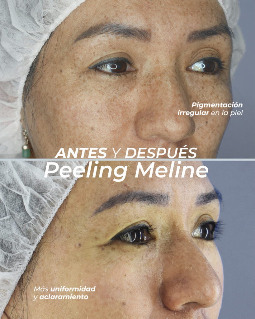 Peeling Meline 3
