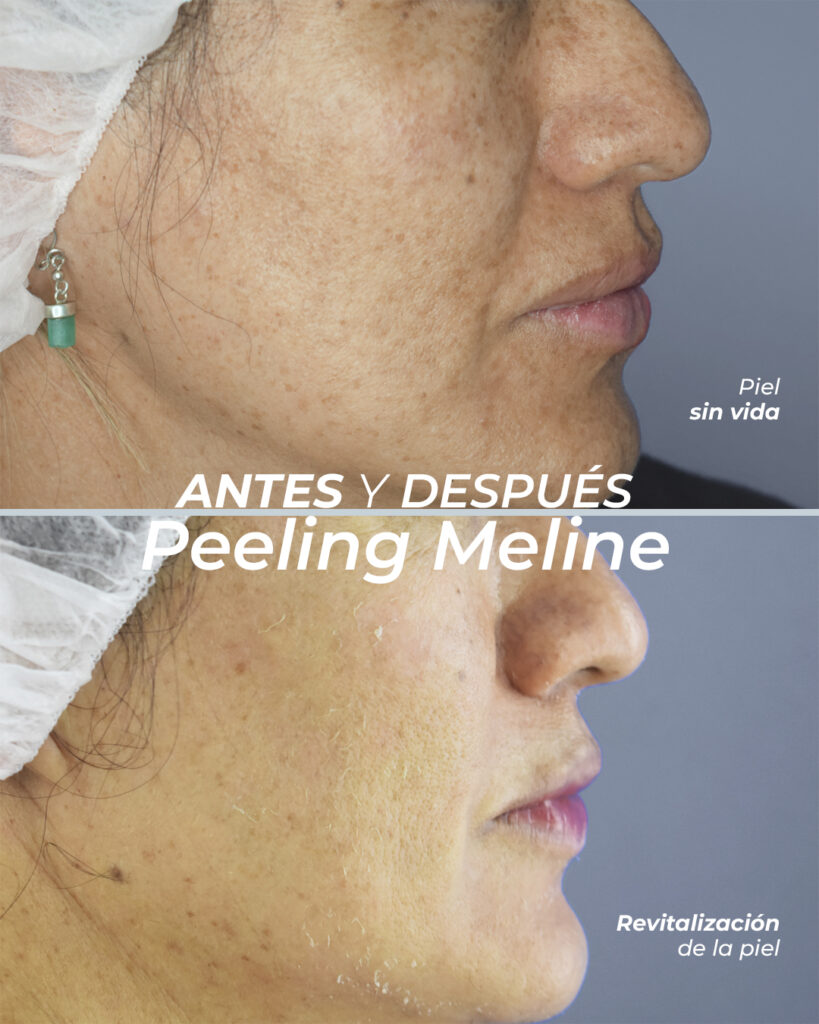 Peeling Meline