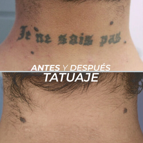 Eliminación de Tatuajes 3