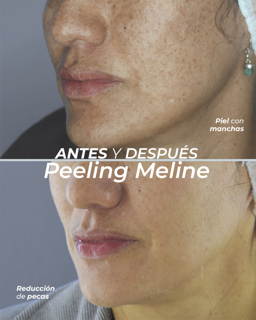 Peeling Meline
