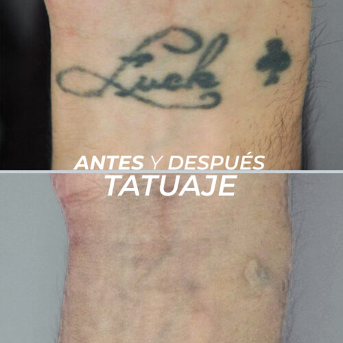 Eliminación de Tatuajes 4