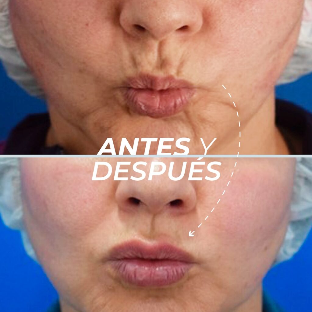 Labios y zona perioral