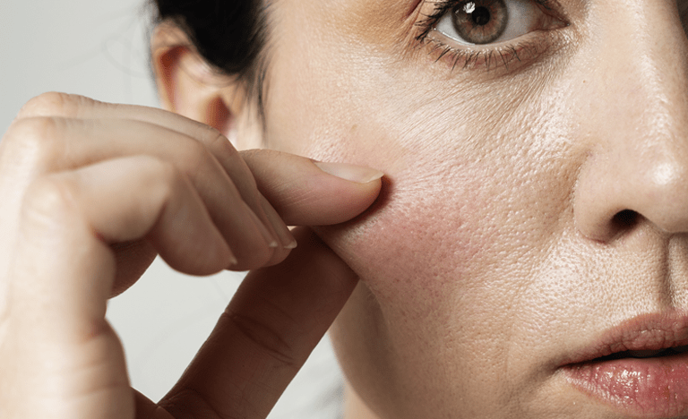 Regeneración-natural-exosomas - Dermosalud Regeneración natural