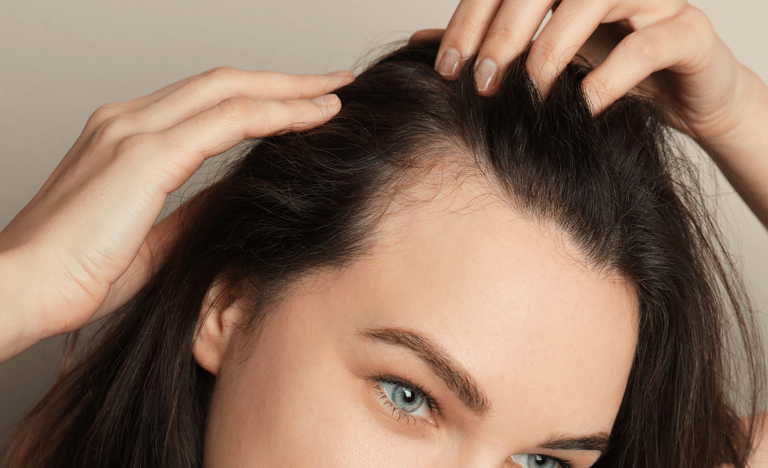 Alopecia-dermosalud-min - Dermosalud alopecia Dermosalud