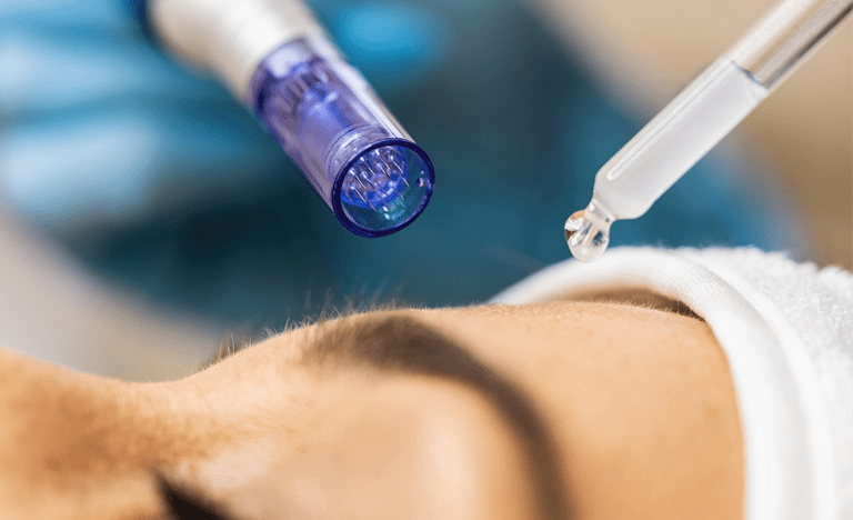 Exosomas-con-microagujas-min - Dermosalud exosomas con microagujas