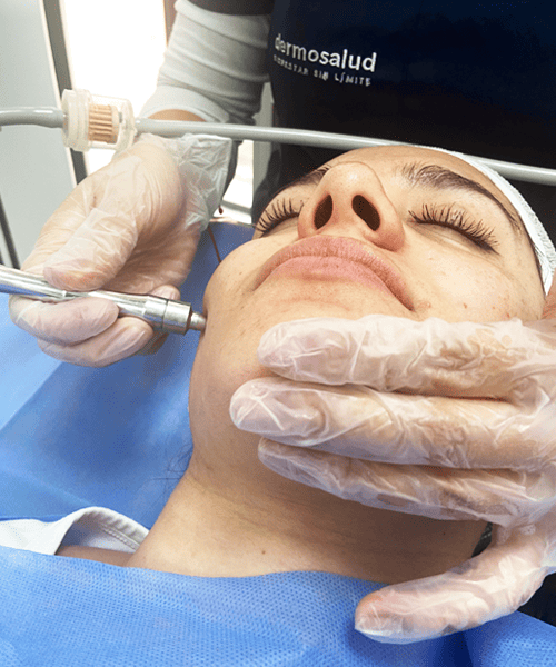 MIcrodermoabrasión